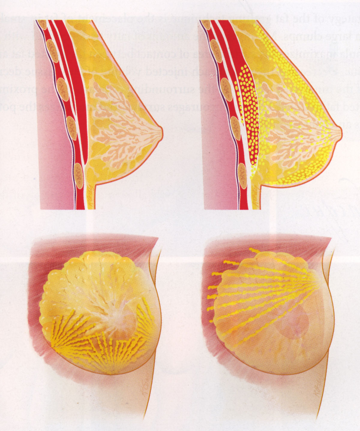 Lipofilling